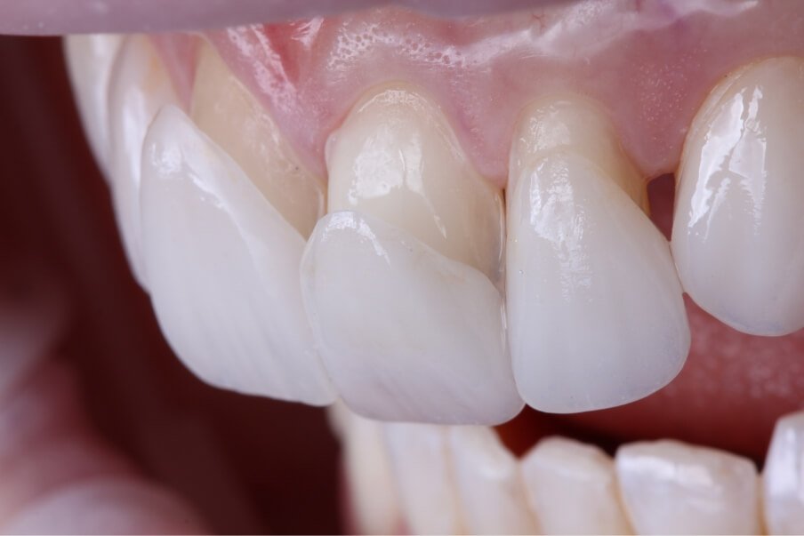 lentes de contato dental