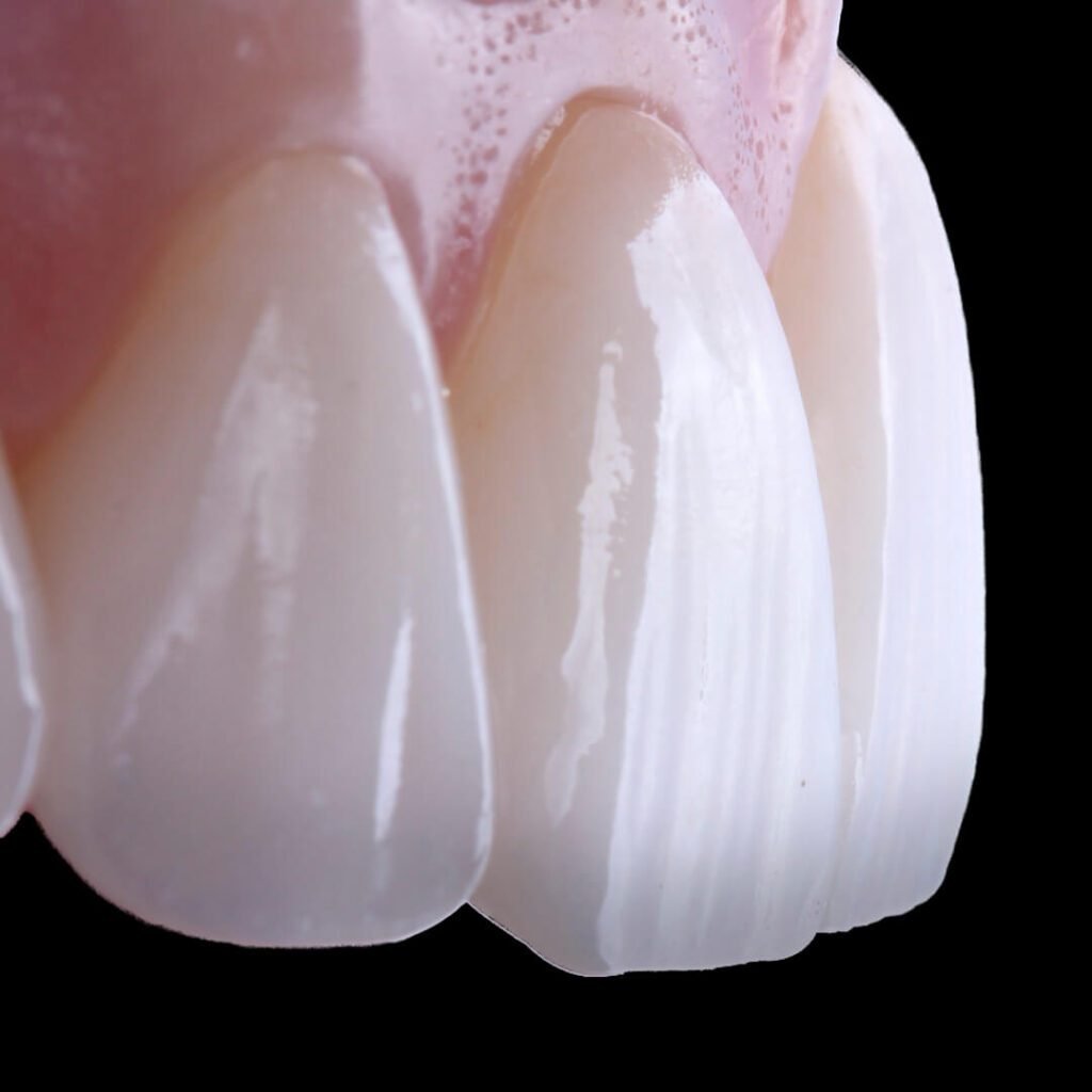 lente de contato dental