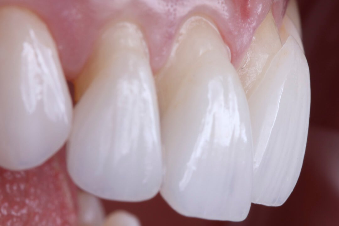 lentes de contato dental